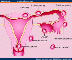 Mirena IUD Causes Cornual Pregnancy