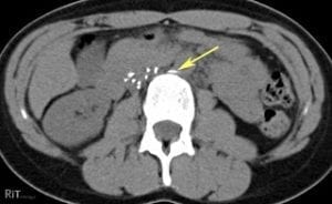 IVC Filter Fracture (CT) - IVC filter MDL