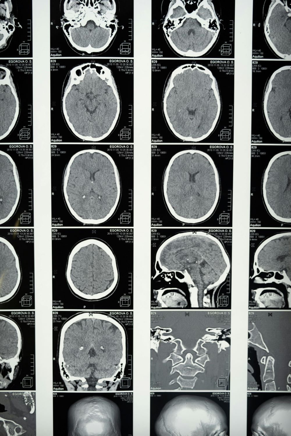 Tandem Repeats Offer Breakthrough in Intellectual Disability