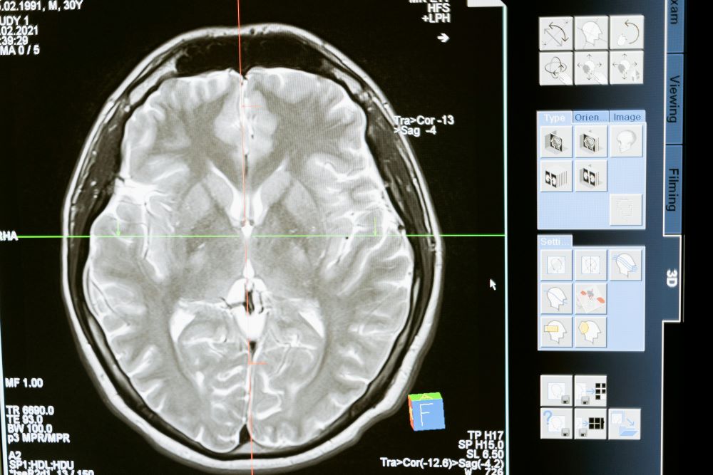 AI-based VirtualMultiplexer Improves Cancer Diagnosis