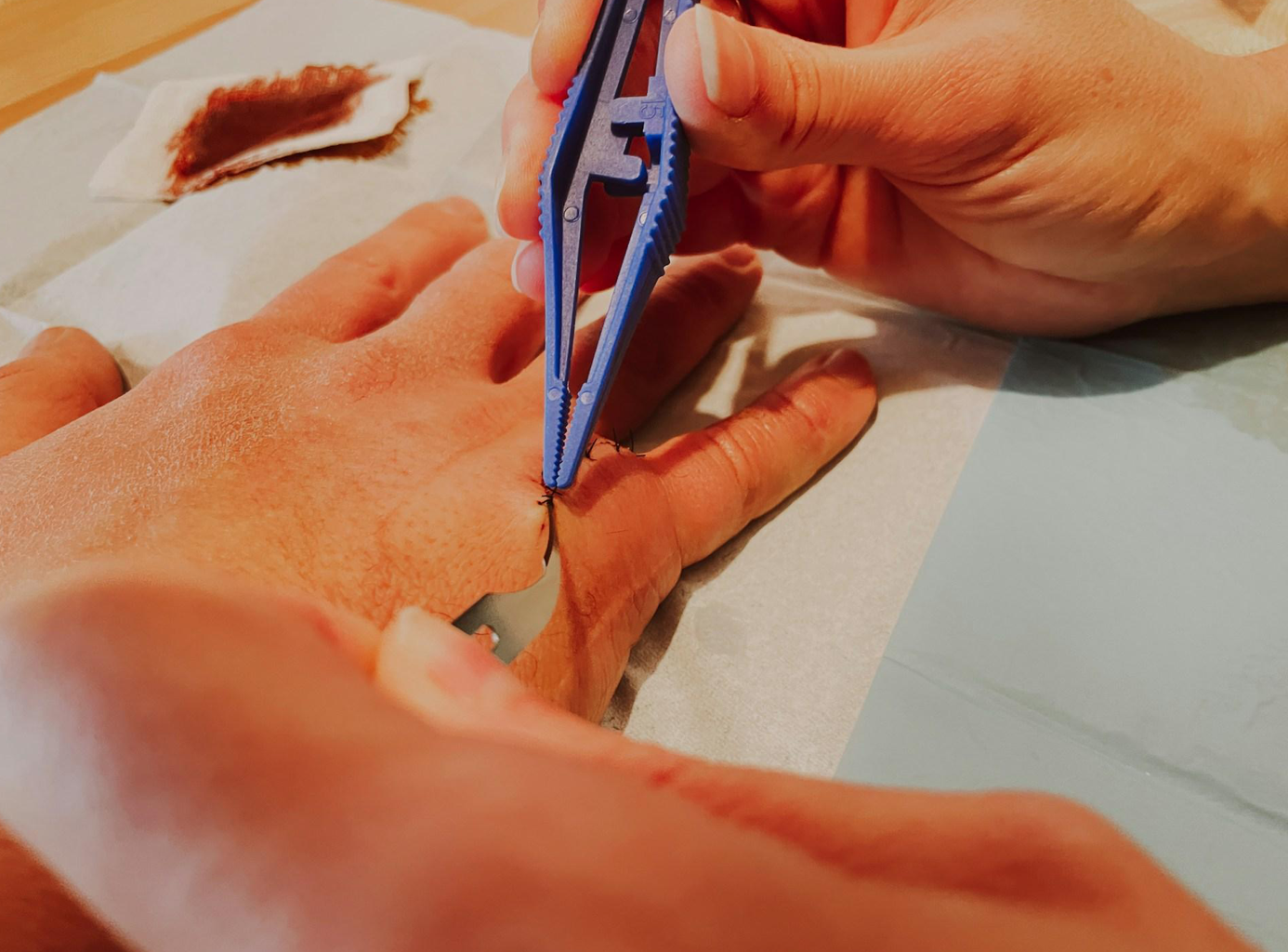 Person getting stitches in back of hand; image by Jametlene Reskp, via Unsplash.com.