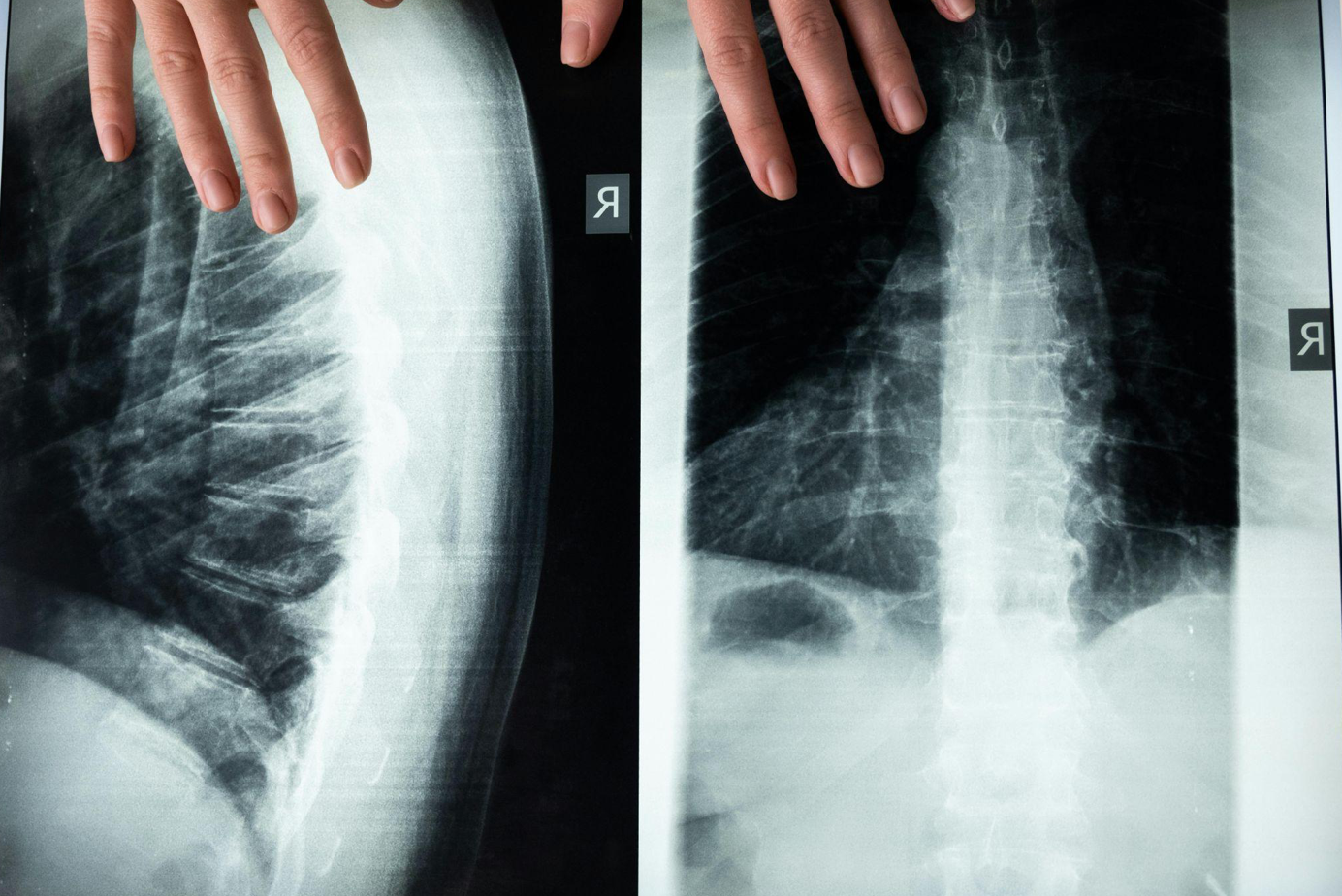 X-rays of the spine; image by cottonbro studio, via Pexels.com.